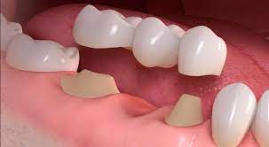 dental implants in bridge
