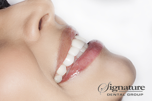 cosmetic dental veneers in Upland CA