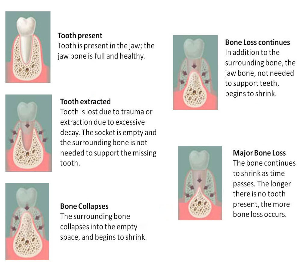 preserving tooth structures and bone