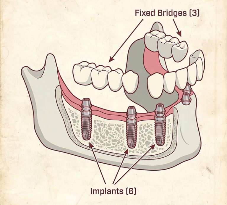 3-on-6 dental implants upland ca